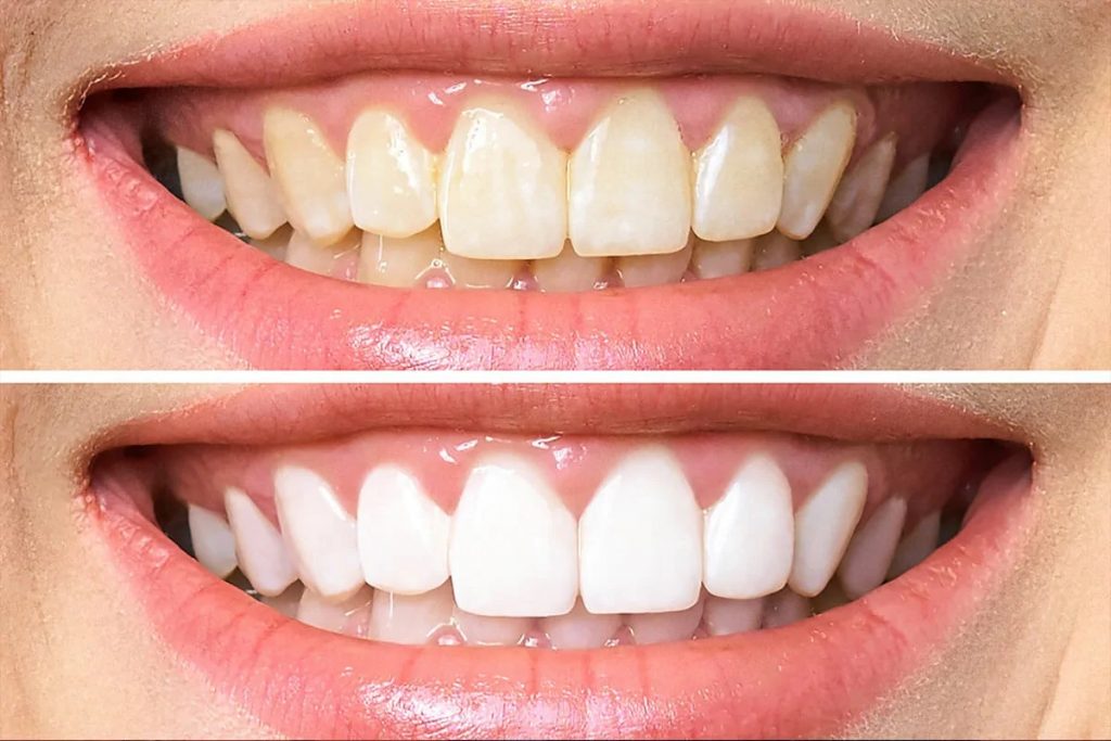 Antes e depois do clareamento dos dentes